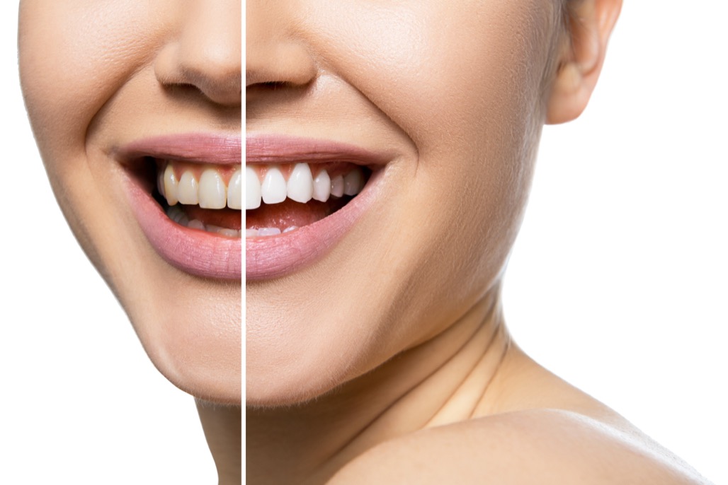 Teeth Whitening Treatment Near Me in White Lake