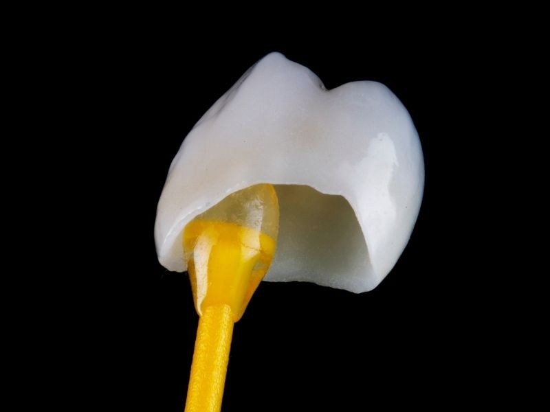 Dental Crowns in White Lake