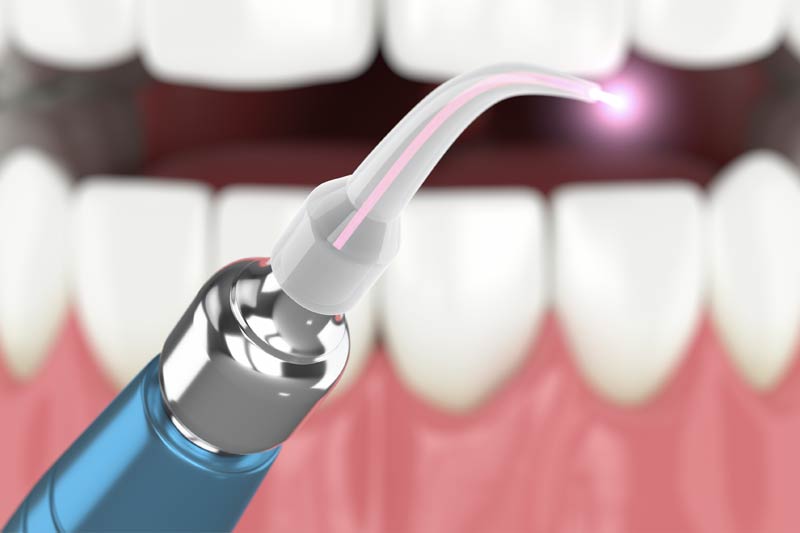 Laser Dentistry