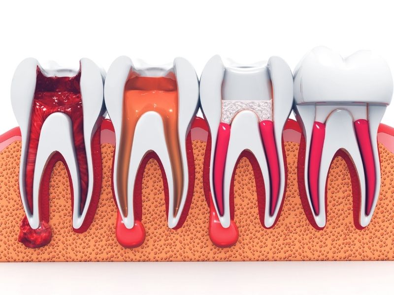 Root Canal in White Lake